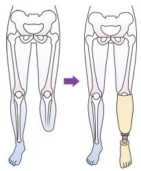 下腿切断