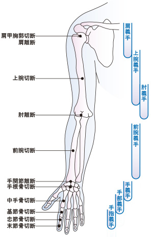 義手のタイプ