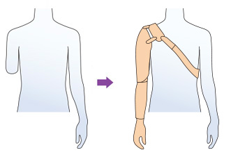 肘～肩で切断した場合