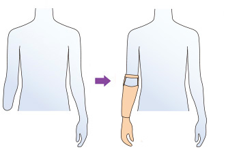 肘～手首で切断した場合